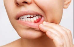 8 Cara Mengobati Sakit Gigi Dengan Bahan Alami