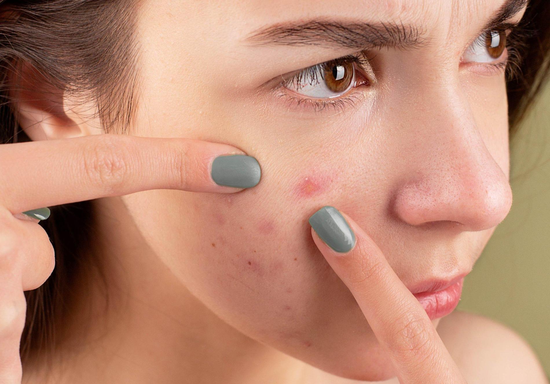 Tips mencegah kembali timbulnya jerawat di wajah.